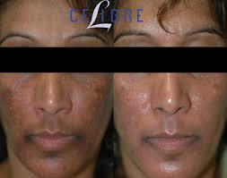 Image result for Melasma