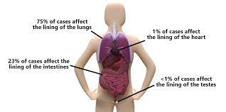 Mesothelioma is an aggressive cancer caused by asbestos exposure. Mesothelioma Miho