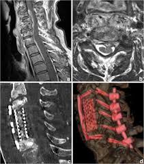 Image result for Spinal Infection