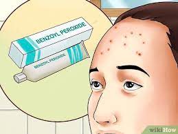 Spots on your forehead and chin, and the sides of your face. 4 Ways To Get Rid Of Forehead Acne Wikihow