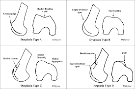 Image result for Patellar Tilt Test