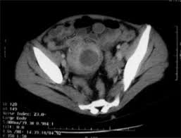People with immune system or respiratory system conditions can experience breathing problems. A Retrospective Series Of Gut Aspergillosis In Haematology Patients Clinical Microbiology And Infection
