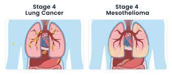 The most common form is pleural mesothelioma which affects the pleura of the lung (the thin membrane surrounding the lungs). Pleural Mesothelioma Vs Lung Cancer Diagnosis Treatment