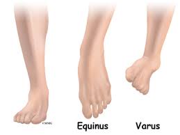 It is possible that club foot shows no physical symptoms and still is present in a patient. Clubfoot Eorthopod Com