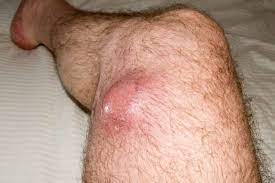 Sarcoma - Universal Hospital
