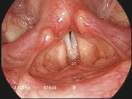 Image result for Functional Aphonia