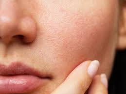 How To Close Open Pores On Face - Types, Causes, Treatment Methods –  Skinkraft