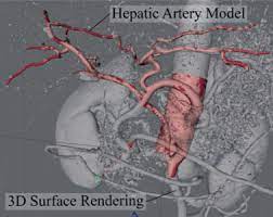 Surrounded by branches of the hepatic artery (oxygen) , portal vein (nutrients) and bile ducts and include a sinusoid which leads to a central vein draining to the hepatic vein. Interpreting Three Dimensional Structures From Two Dimensional Images A Web Based Interactive 3d Teaching Model Of Surgical Liver Anatomy Hpb