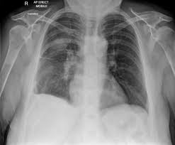 Pleural effusion refers to a buildup of fluid in the space between the lungs and the chest cavity. Parapneumonic Effusion Loculated Radiology Case Radiopaedia Org