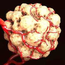 Tumor Vessels 3d Obj Tumor Vessel 3d Model