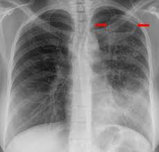 According to kahn, a small pneumothorax cavity containing from 200 to 500 cc. Pneumologie Unsere Krankheitsbilder Im Rontgenbild
