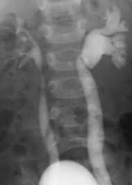 Image result for Voiding Cystourethrogram