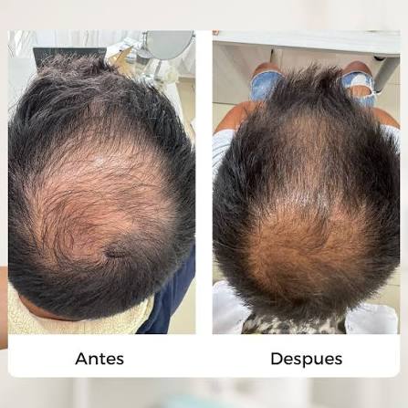 En estas ultimas semanas las consultas por caida de cabello aumentaron notablemente‼️ 📌La caida de cabello en muchos casos puede ser muy preocupante para quien la padece, por esto, a veces los