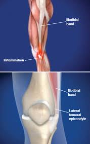 The femoral artery enters while the femoral vein leaves the thigh just under the inguinal ligament. Iliotibial Band Syndrome Itbs Central Coast Orthopedic Medical Group
