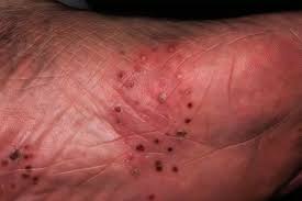 Image result for dyshidrosis