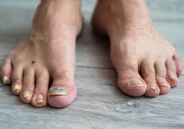 Image result for mykoza nehtů