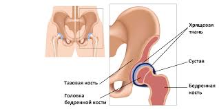Откуда берётся боль в тазобедренном суставе и что с ней делать — Лайфхакер