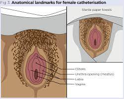 Indwelling urinary catheter insertion 2: procedure for adults | Nursing  Times