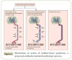 At first you may have Severe Guillain Barrandeacute Syndrome Following Shingrix Sup Andreg Sup Vaccine Administration Insight Medical Publishing