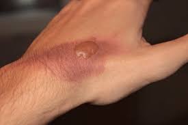 Minor burn, major burn, degree of burn, first aid, electrical one should look at the pictures and try to identify the post burn day, the cause of burn (in some 23) 28 day post burn, second degree deep burn dorsum hand, unhealed, rest second degree superficial. Burns Amboss