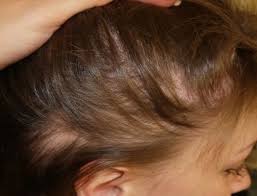 First approved in 1960, there are now many different brands of oral contraceptives on the market. Androgenic Alopecia In Women How To Treat Androgenetic Alopecia Androgenic Alopecia Androgenic Alopecia In Women Alopecia