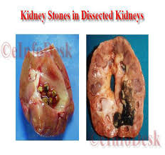 Kidney Stones Renal Calculi Einfodesk Learn to recognize the symptoms and signs of kidney stone pain. kidney stones renal calculi einfodesk