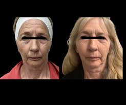 Skin Resurfacing — StrotherDermatology.com