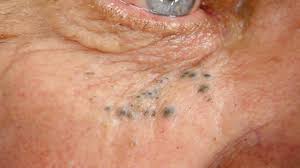 Those lesions are mainly located in the face, especially in the malar and periorbital areas. Solar Comedones Symptoms Causes Risks And Treatment