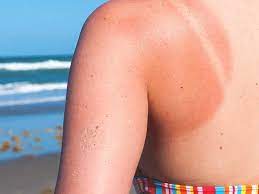 Read more about risk, symptoms, and exposure to sun causes most of the wrinkles and age spots on our faces, and it can lead to much more serious consequences, including skin cancer. Sunburns And Damage To Your Body