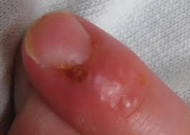 Herpes results from infection with the herpes simplex virus (hsv). What Does Herpes Look Like Pictures Treatment And Prevention