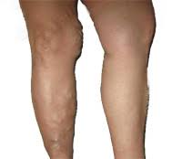 12 surya namaskaras/ಸೂರ್ಯ ನಮಸ್ಕಾರ are practiced per cycle are have great health benefits. Varicose Veins Yoga Yoga For Varicose Veins Yoga Poses For Varicose Veins Varicose Veins Yoga Therapy Yoga And Varicose Veins Asanas For Controlling Varicose Veins Yoga