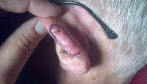 My husband has just been told a spot near his ear lobe is cancerous. Skin Cancer Detection Every Clinician S Responsibility Clinical Advisor