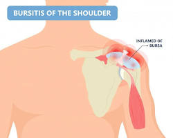 Image of Bursitis shoulder