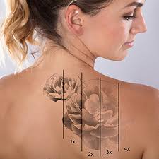 Removing a tattoo with removal creams may take a while as the tattoo will be removed bit by bit compared to the removal creams, dermabrasion has a higher success rate regarding tattoo removal. Picosure Laser Tattoo Removal Dr Dana Md