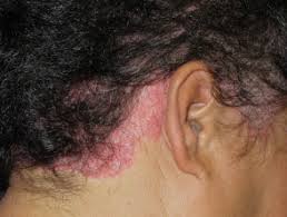 Hair loss appears quite rarely. Diagnosis Of Scalp Rashes Dermnet Nz
