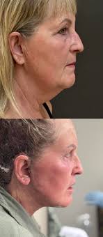 Face-lift & Neck-lift Support Group