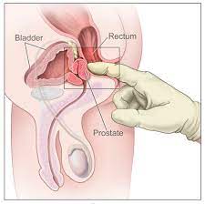 Prostate massage - Wikipedia