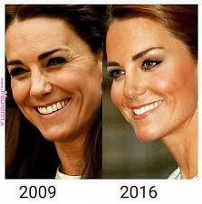 Diese fotos sind echt zum fürchten. Image Result For Dermal Fillerprotocol Stars Ungeschminkt Falten Stirn Botox Stirn