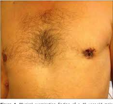 About 1 out of every 100 breast cancers diagnosed in the united states is found in klinefelter syndromeexternal icon is a rare genetic condition in which a male has an extra x chromosome. Pdf Favorable Long Term Outcome In Male Breast Cancer Semantic Scholar