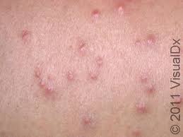 Image result for flea bites