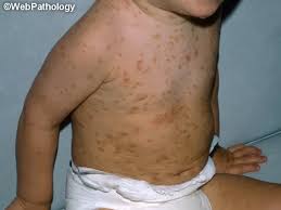 Image result for Urticaria pigmentosa children