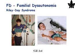 It is present almost exclusively in ashkenazi jewish individuals and has a poor prognosis. N To C Terminal 5 To 3 Cds