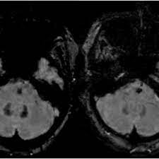 An introduction to network switches. Susceptibility Weighted Imaging Swi Technique And Its Role In Clinical Neuroimaging Eurorad