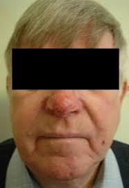 Coblation of rhinophyma