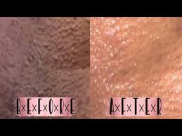 Reshape and tone your body using safe and effective treatments that are a fraction of the cost, with no pain or down time. Best Bleaching Creams For Private Areas In 2021 Test10best