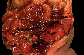 Image result for Necrotizing Enterocolitis