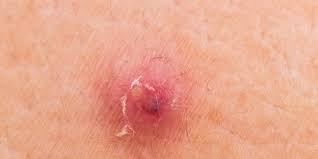 It is easy to tell genital warts apart from herpes or ingrown hair bumps. Bumps You Should Never Pop Prevention