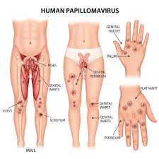 Image result for human papillomavirus symptoms