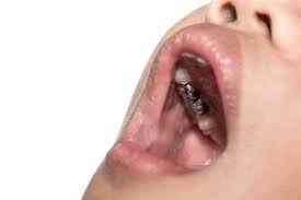 Dental Crowns For Kids Why And What To Expect