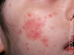Image result for ekzema face